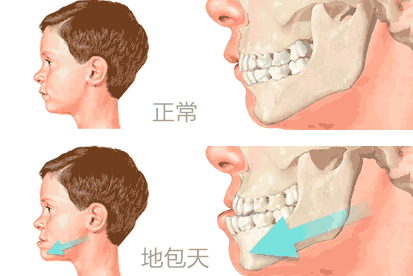 地包天如何治疗好